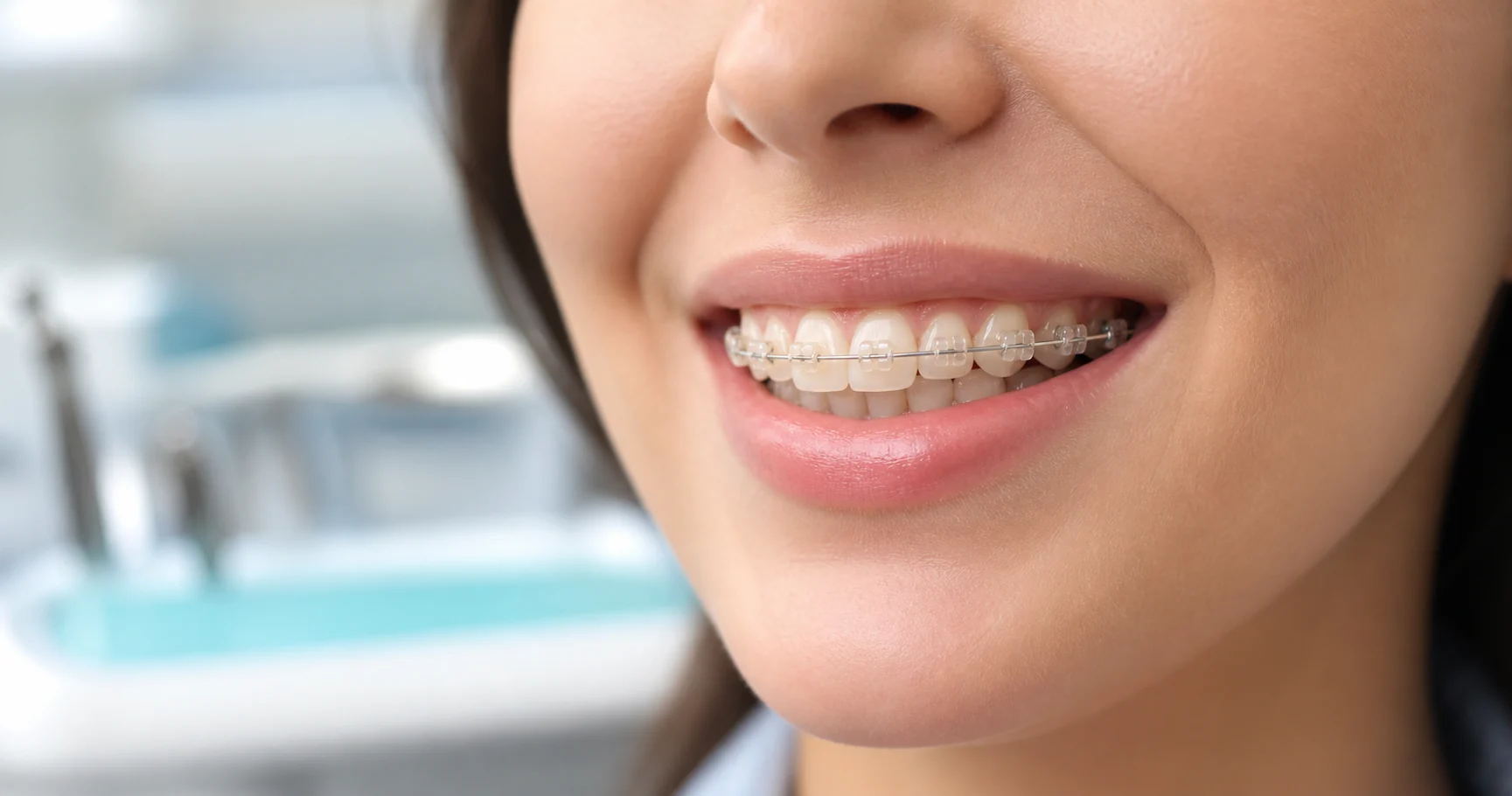 براکت سرامیکی بهتر است یا براکت فلزی؟