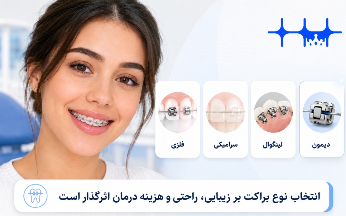 انواع براکت ارتودنسی ثابت