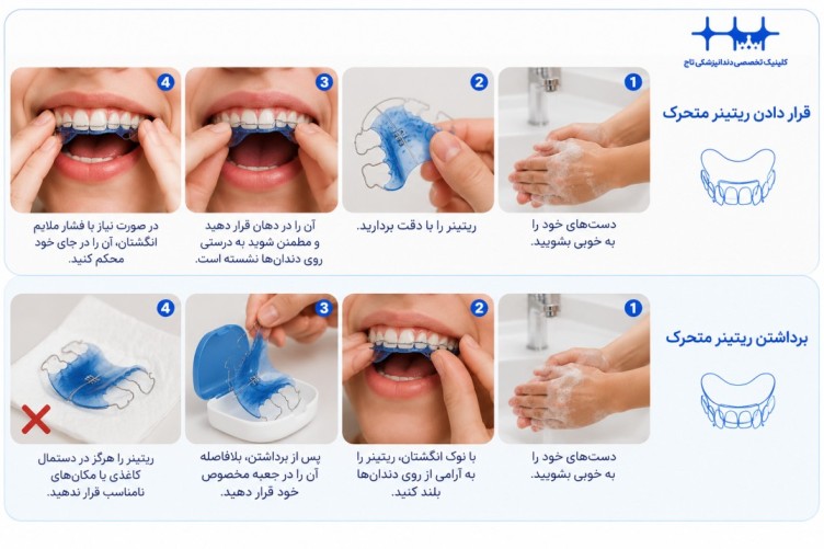 نحوه قرار دادن و برداشتن نگهدارنده ارتودنسی